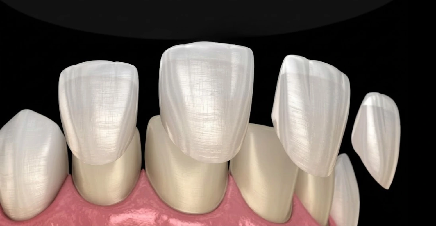 Resin Veneers in Turkey 2